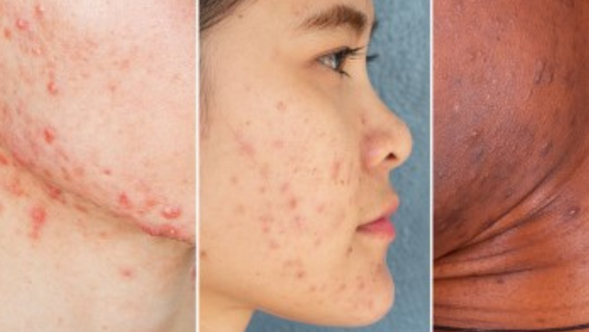 pregnancy acne