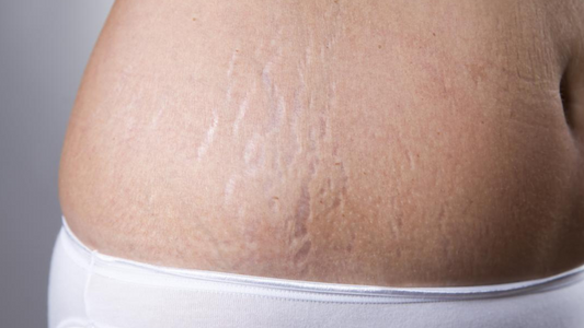 stretch marks images