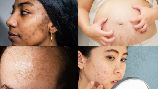 Skin Issues During Pregnancy